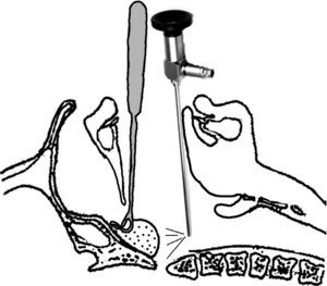An illustration for the procedure shows the adenoid curette is inserted into the nasopharynx while the 70° nasal endoscope is introduced behind it.