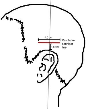 Vestibulocochlear line according to Chinese scalp acupuncture.