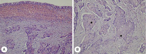 Histopathologic findings of case 1. (A) Infiltrating keratinizing carcinoma of the nasopharynx is noted beneath normal ciliated columnar pseudostratified epithelium (H&E, ×200). (B) Nasopharyngeal keratinizing carcinoma infiltrating orbital soft tissue exhibits distinct cytoplasmic keratin formation with pearl formation () (H&E, ×400).