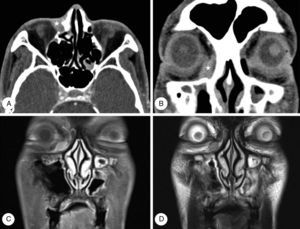 Computed tomography (CT) and magnetic resonance (MR) images of case 1. Axial (A) and coronal (B) CT images reveal a soft tissue mass with indistinct margins on the inferomedial side of the right orbit (). MR images reveal an oval-shaped orbital mass displaying mild enhancement on post-contrast T1 images (C) and intermediate signal intensity on T2 images (D).