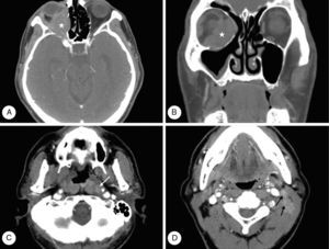 Computed tomography (CT) images of case 2. Axial (A, C, D) and coronal (B) images reveal a soft tissue mass () in the extraconal and intraconal space of the right orbit. Moreover, asymmetry of the left nasopharynx and metastatic lymph nodes is noted in the level II (black arrow) and retropharyngeal areas (white arrow) of the left neck.