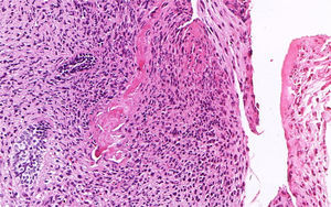 Histopathological aspects showing deposition of dentinoid-like material. (H&E stain, 200×).