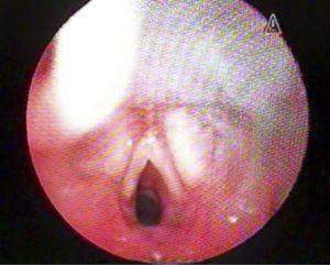 Flexible fiberoptic laryngoscopy after extubation: normal subglottis; mild posterior glottic edema.