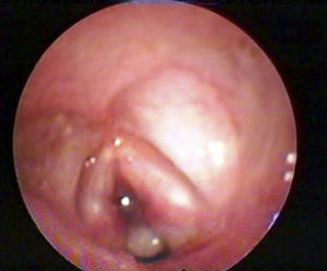 Flexible fiberoptic laryngoscopy after extubation: extensive anterior subglottic granulation.
