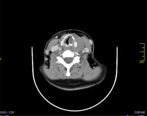 Laryngeal infiltration with cartilage invasion of thyroid mass.
