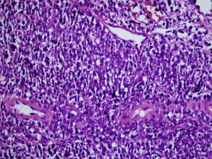 Tumor is composed of atypical lymphoid cells, which have a large vesicular nucleolus and significant nucleolus. These cells have positive membranous positivity with CD 20 marker (with 400× magnification on pathologic examination).