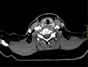 Neck computed tomography after treatment shows only minimally laryngeal edema, without any mass in both larynx and thyroid gland (one month after treatment).