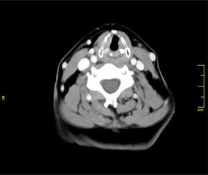 Neck computed tomography six months after treatment. Laryngeal edema has decreased a little more over time.
