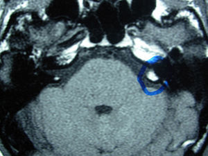 Magnetic resonance imaging shows the lesion (circled in blue).