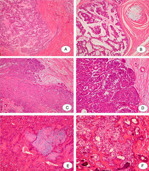 Frankly invasive myoepithelial carcinoma: (A) Island of myoepithelial cells infiltrating the tissue (H&E×10); (B) cords of pleomorphic myoepithelial cells surrounded by myxoid stroma. Note the reaction against thread suture from previous surgery in the top right side of the image (H&E 20×). Frankly invasive epithelial-myoepithelial carcinoma: (C) Proliferation of epithelial and myoepithelial cells in a nodular growth (H&E 10×); (D) Small lumen bounded by eosinophilic, cuboidal, intercalated duct-like cells. These cells are surrounded by small and non-staining cytoplasm cells. Note the maintenance of basal cells in the periphery of nest cells surrounded by fibrous septa (H&E 20×). Minimally invasive epithelial-myoepithelial carcinoma: (E) Epithelial-myoepithelial proliferation arising in pleomorphic adenoma residual (H&E 10×); (F) eosinophilic, hyalinized basal lamina material surrounds nests of tumor cells and ductal structures comprised of epithelial and myoepithelial cells (H&E 20×).
