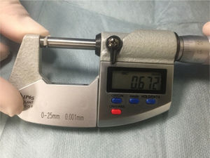 Measurement of the thickness of tragal cartilage using a micrometer.