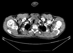 CT scan of the first patient, showing a nodular mass with dystrophic calcification.