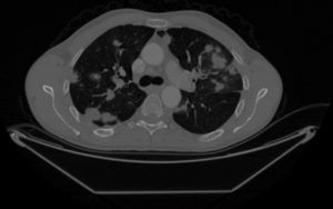 Multiple intraparenchymal and subpleural metastatic nodules in the thorax CT of the first patient.