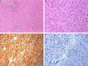 (a, b) Photomicrograph of Case 1, showing spindle cell tumor arranged in fascicular pattern with eosinophilic cytoplasm (hematoxylin and eosin ×100, ×400). (c) Tumor cells showing diffuse actin positivity (×200) and (d) focal desmin positivity (×400).