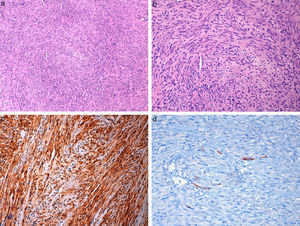 (a, b) Photomicrograph of Case 2, showing spindle cell tumor similar to Case 1 (hematoxylin and eosin ×100, ×200). (c) Tumor cells showing diffuse actin positivity (×200) and (d) focal desmin positivity (×400).