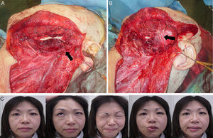 Intraoperative view and result of facial nerve interpositional graft technique (Patient 10). (A) The patient had left extended total parotidectomy and left radical neck dissection, the black arrow points to the facial nerve stump. (B) Primary facial nerve reconstruction with interposition of a nerve graft using cutaneous cervical nerves (marked by black arrow) was done. (C) Improvement in facial function up to HB grade III with no synkinesis.