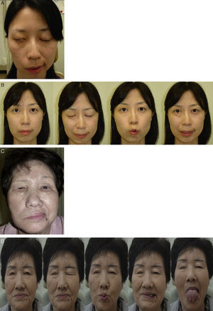 Pre and post-operative result of direct end-to-side FHA technique (Patient 4 and 7) (Patient 4; Facial N Res Jpn 30: 186–189, 2010). (A) Preoperative photo (Patient 4); (B) postoperative facial function shows HB grade III with mild synkinesis (Patient 4); (C) preoperative photo (Patient 7); (D) postoperative facial function shows HB grade III with no synkinesis and normal tongue movement (Patient 7).