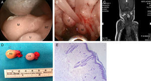 (A) Hairy polyp originating from the posterior pillar of the right tonsil (M, mass; U, uvula; RT, right tonsil). (B) Hairy polyp originating from the posterior pillar of the left tonsil elongating through the nasopharynx (M, mass; u, Uvula). (C) Magnetic resonance image of the hairy polyp originating from the posterior pillar of the right tonsil. (D) The excised specimens (RS, right specimen; LS, left specimen). (E) Keratinized squamous epithelium on the surface and mesenchymal tissue components, such as hair follicles lining the fibroadipose core (HE 40×).