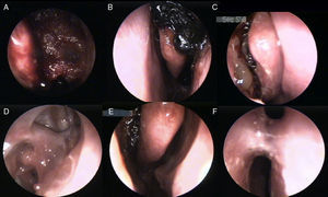 NasoPore at the end of surgery (A) and resorption process at 2nd, 10th, and 30th day (B–D), as well as some remnants of dressing after ten days post operation (E) and synechia formation (F).
