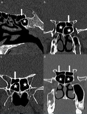 A coronal CT scan of the paranasal sinuses shows (a) sagittal image an Onodi cell; (b) coronal image of a left Onodi cell; (c) coronal image of a right Onodi cell; (d) coronal image of bilateral Onodi cells (arrow, Onodi cells; asterisk, sphenoid sinuses).