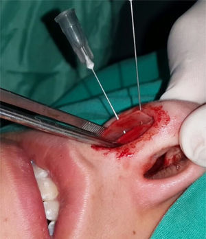 Application of caudal septal extension graft (CSEG).
