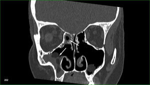 CT scan of the sinuses. Polyposis of the maxillary and ethmoid sinuses (white arrows) in a patient after previous sinus surgery, who underwent allogeneic hematopoietic stem cell transplantation because of primary myelofibrosis.