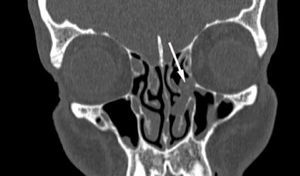 CT scan of the sinuses. A polyp obstructing osteomeatal complex (white arrow) in a patient diagnosed with acute myeloid leukemia, qualified for allogeneic hematopoietic stem cell transplantation.