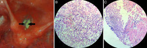 (A) Fiber-optic laryngoscopy revealed inflamed vocal cords covered with dirty white necrotic debris (arrows) that resembled keratotic patches over areas of congestion. (B and C) Histopathology revealed necrotic exudates in tissue stroma crowded with septate “spaghetti-like” fungal filaments branching at ∼45°, interspersed with shreds of vocal cord squamous epithelium (hematoxylin–eosin; 400×).