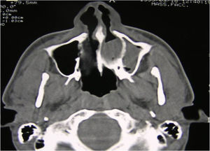 Axial CT scan, monolateral left bony choanal atresia.