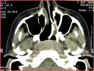 Axial CT scan, monolateral left mixed choanal atresia.