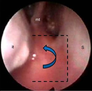 Endoscopic view: intranasal incisions on the atretic plate, fashioning a lateral flap (dotted lines). it, inferior turbinate; mt, middle turbinate; S, septum.