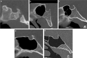 Sinus classification. Midsagittal reformatted images obtained from CT scans. (a–e) Types 1 through 5 sphenoid sinuses, respectively.