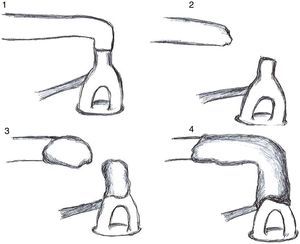 Schematic drawing of the four attempts at ossicular chain reconstruction with resin cement.