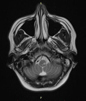 Axial T2-weighted magnetic resonance imaging of the brain with hyperintense signal in the posterior inferior bulb region.