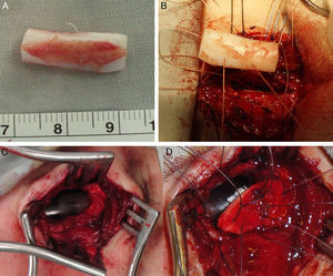 Grafting. (A) LTR using a modified boat for anterior grafting in a 15yo Down syndrome girl with anterior SGS 2ry to a high long-standing high tracheostomy. (B) Graft being fixed to the expanded cricoid cartilage. (C) Anterior tracheal defect 2ry to loss of cartilage and formation of fibrosis (that was excised) 2ry to a traumatic and long-standing tracheostomy in a 16yo boy. (D) Reconstruction using auricular cartilage graft.