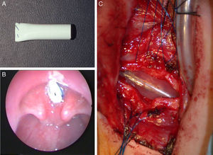 Stenting. (A) Silicone stent superiorly sutured to avoid aspiration during feeding. (B) Stent in place with upper end placed above the vocal cords to avoid inducing subglottic granulation tissue in a 3yo boy with posterior glottic stenosis. (C) Intraoperative view of an inserted stent in a 1yo with congential SGS.