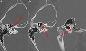 CT images of the left temporal bone of a 12 year-old girl with left Bell's palsy. The arrow indicates the facial nerve canal. (A) Labyrinthine segment, (B) tympanic segment, (C) mastoid segment.