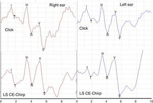 Example of ABR recording with Click and LS CE-Chirp® stimuli in one subject. Observe the much higher amplitude of wave V in response to the LS CE-Chirp® and similar latencies in response to Click and LS CE-Chirp® on both sides.