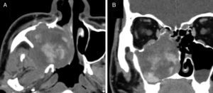 Enhanced CT in Case 1. Axial (A) and coronal (B) images. A strong, spreading, and gradually increasing contrast effect is seen during the arterial phase.