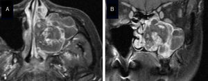 Gadolinium-enhanced MRI of Case 2. Axial (A) and coronal (B) images. A heterogeneously enhanced vascular tumor was suspected.
