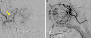 External carotid arteriography of Case 3. Frontal (A) and profile (B) views, showing tumor staining in the area corresponding to the entire right maxillary sinus. Sphenopalatine artery (arrow).