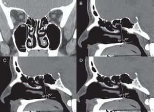 (A) Coronal CT image demonstrating the vertical distance from the nasal floor (NF) to the highest medial maxillary sinus roof (MS) and posterior ethmoid skull base (PE). (B) Sagittal CT image demonstrating the vertical distance from the nasal floor (NF) to the sphenoid ostium (SO). (C) Sagittal CT image demonstrating the vertical distance from the nasal floor (NF) to the anterior sphenoid sinus roof (SR). (D) Sagittal CT image demonstrating the vertical distance from the nasal floor (NF) to the anterior sphenoid sinus floor (SF).