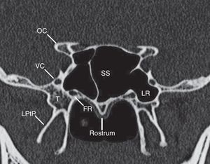 The coronal section at which both the vidian canal and foramen rotundum are visualized (usually at the midpoint of sphenoid sinus). SS, sphenoid sinus; FR, foramen rotundum; VC, vidian canal; LPtP, lateral pterygoid plate; OC, optic canal; LR, lateral recess.