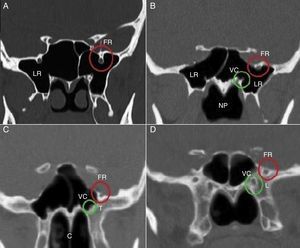 Foramen rotundum (FR), vidian canal (VC) and sphenoid sinus (SS) pneumatization classifications. A, FR type I and SS lateral recess (LR); B, FR type IIa, VC type I and SS lateral recess (LR); C, FR type IIb, VC type II and SS left side tangent (T); D, FR type III, VC type III and SS less pneumatized (L). NP, nasopharyngeal; C, choana.
