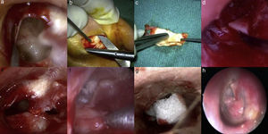 Endoscopic transcanal tympanoplasty. At first, a minimal amount of tissue removed in order to get back to fresh edges (A); both grafts harvested from one side (B) and their shapes were designed based on the perforations (C). A wedge of cartilage was used over promontory to hold the cartilage (D); or in some cases, a small piece of cartilage was placed into the hypotympanum (E). The graft was placed with underlay technique while perichondrium layer facing laterally (F); for preventing displacement of the graft, small pieces of gelfoam were placed over cartilage into the canal (G). Post operative result (H).