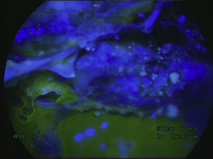 Fluorescein-stained cerebrospinal fluid fistula with a CSF leak, with a blue light filter.