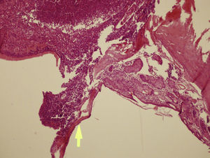 There is no significant tympanosclerosis (arrow) in this sample of control group; with moderate otitis media (left side of arrow). H&E stain, 100× magnification.