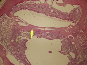 Mild tympanosclerosis (arrow) and mild otitis media (below the arrow) are demonstrated on a sample of melatonin group. H&E stain, 100× magnification.