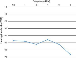 Profile of hearing loss according to average hearing threshold in frequencies.