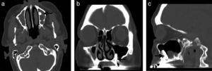 Computed tomography (CT) scan showed dental implant (arrow) inside left maxillary sinus in axial (a), coronal (b) and sagittal (d) view.